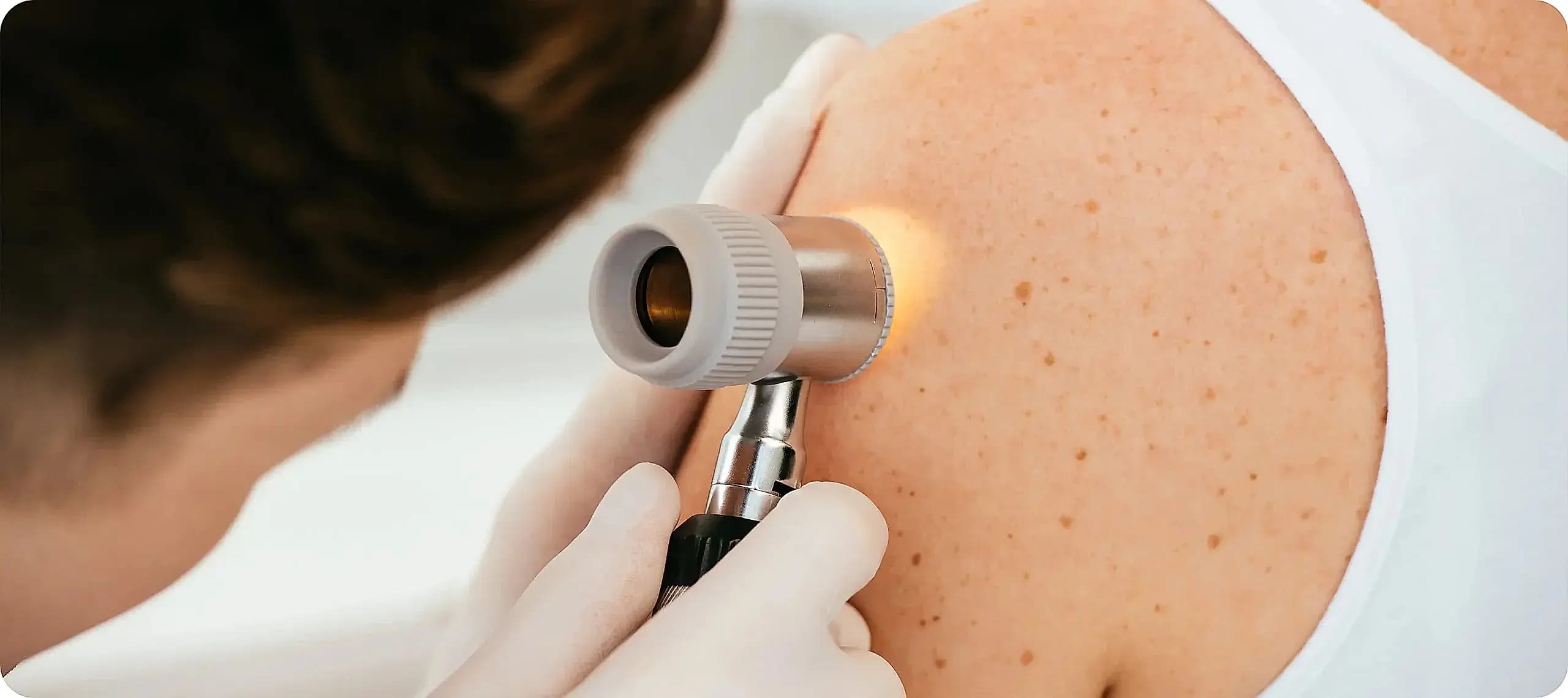 Deri ve Zührevi Hastalıklar (Dermatoloji)